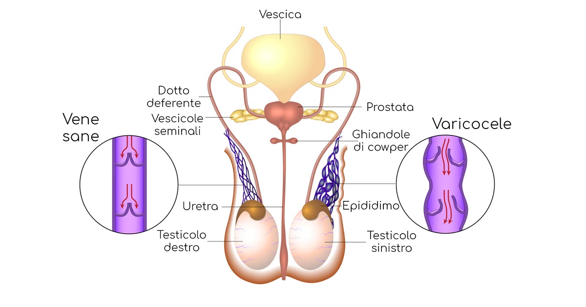 varicocele