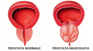 prostatite cronica cura