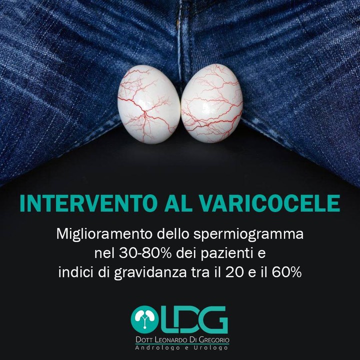 varicocele