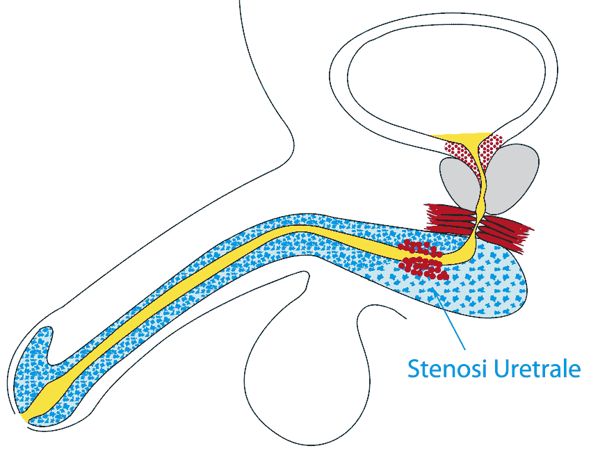 stenosi uretrale