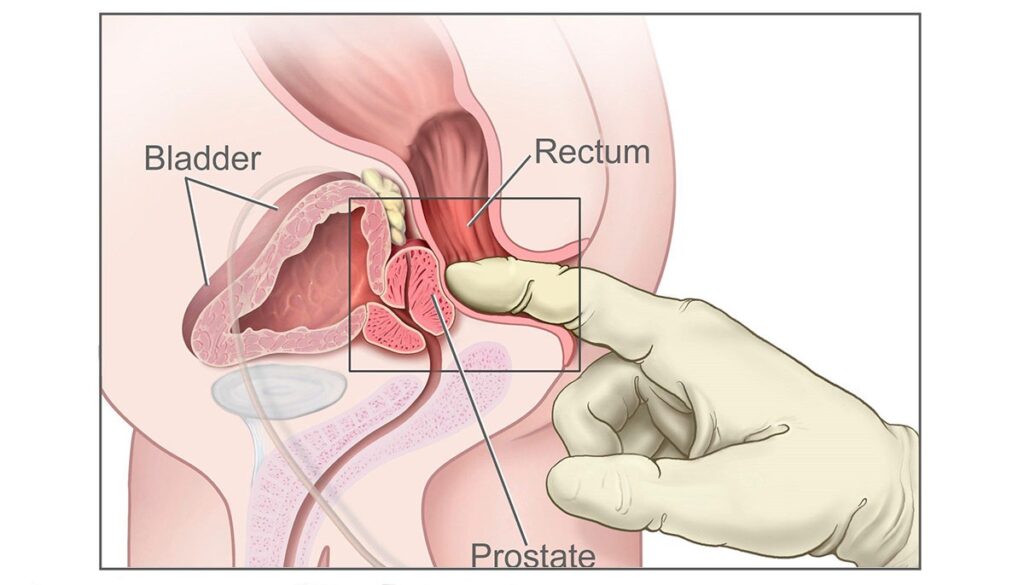 ipertrofia prostatica benigna cos'è