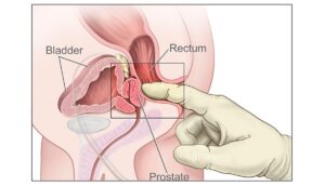 ipertrofia prostatica benigna cos'è