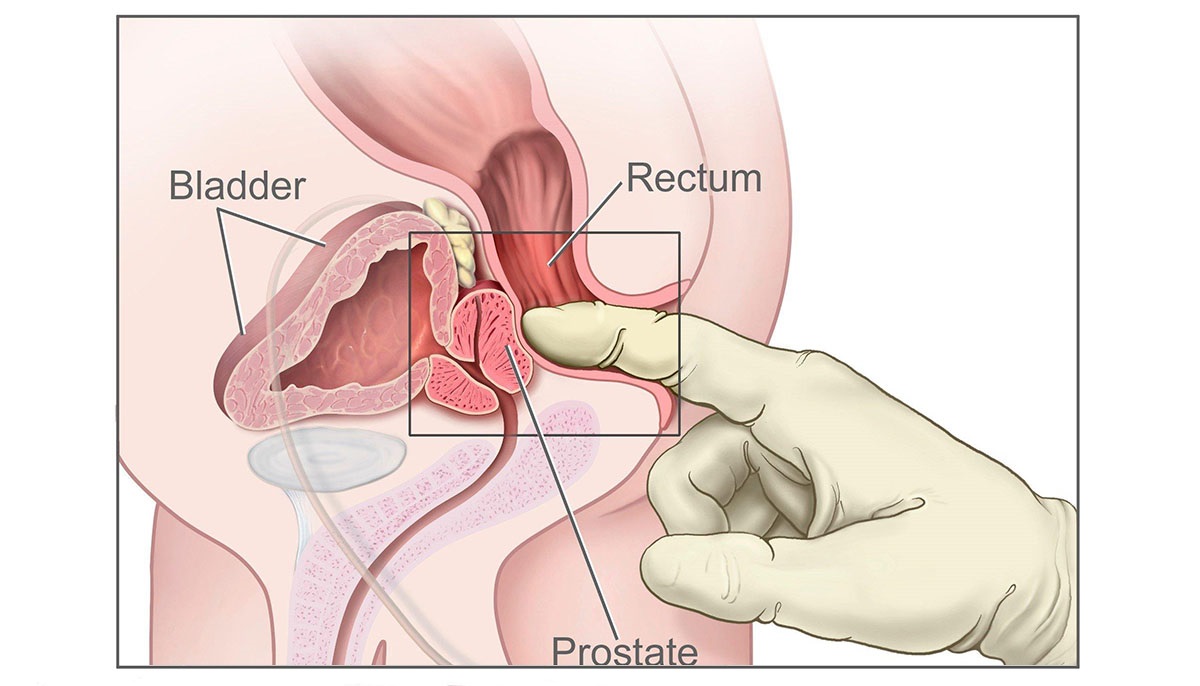 la prostata è ereditaria