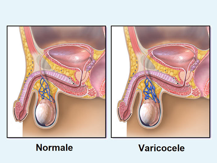 Varicocele img
