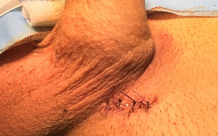 ferita-intervento-varicocele2