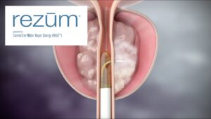 rezum trattamento ipertrofia prostatica benigna