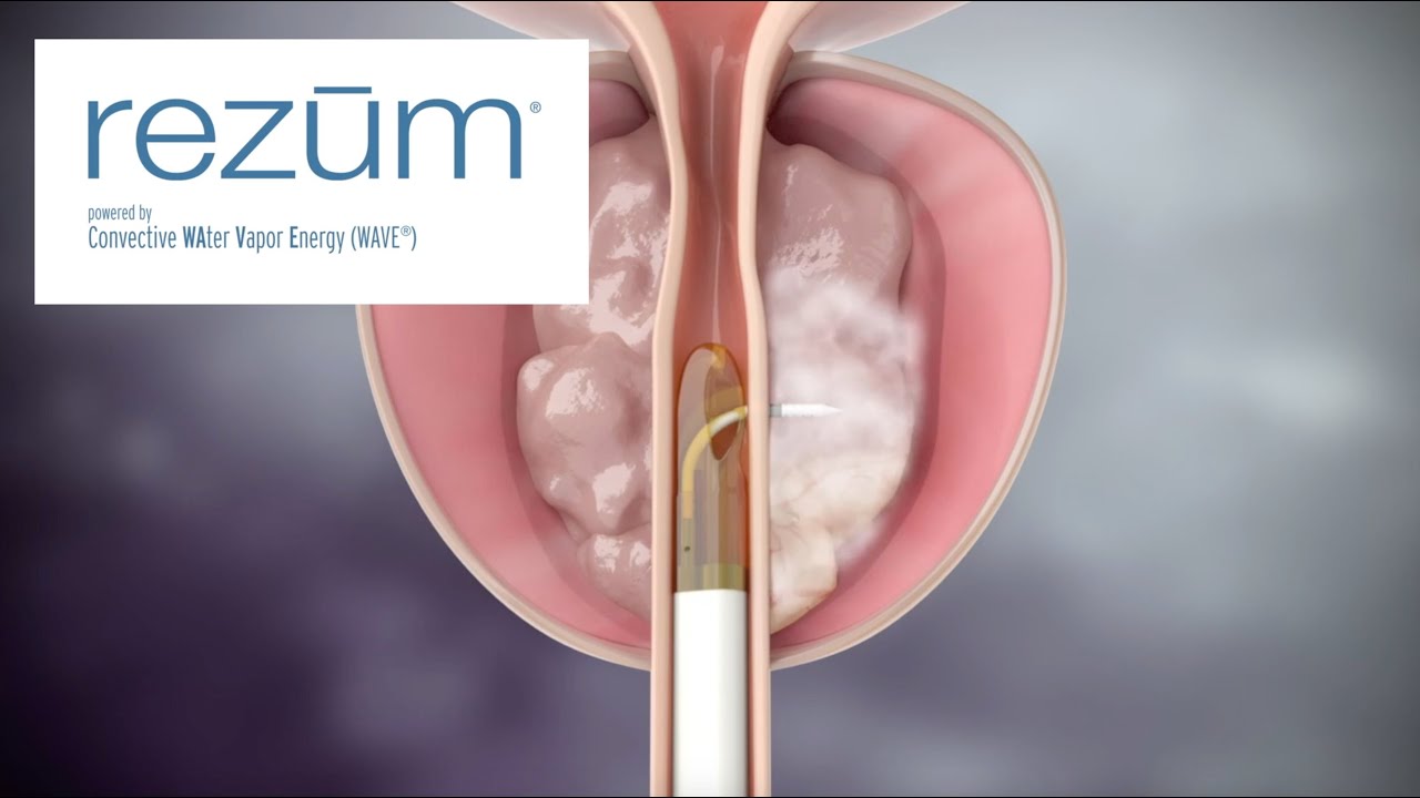 rezum trattamento ipertrofia prostatica benigna