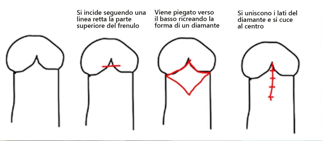 intervento di frenuloplastica palermo